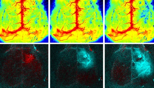 Cortical spreading