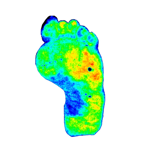 pericam psi diabetic foot