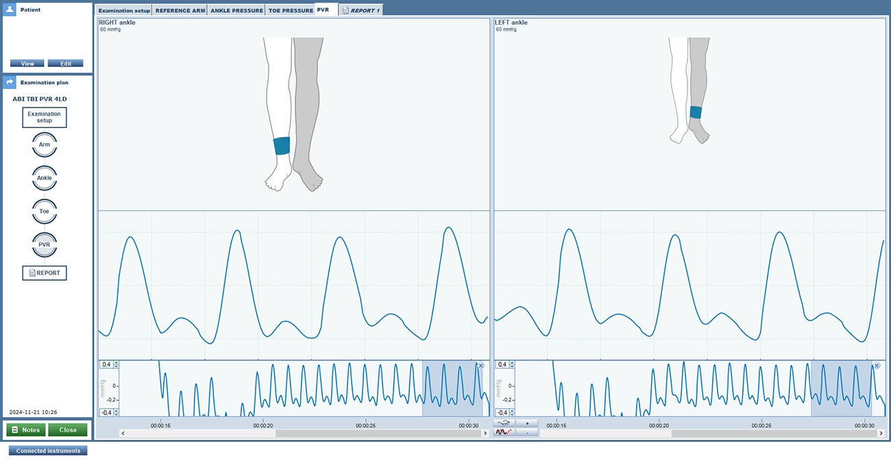 periflux 6000 combined system pulse volume recording running