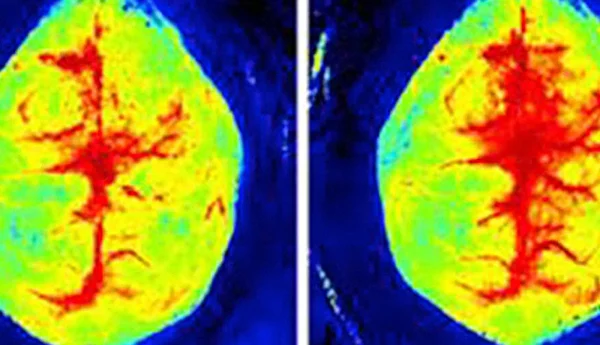 Middle cerebral artery occlusion (MCAO)