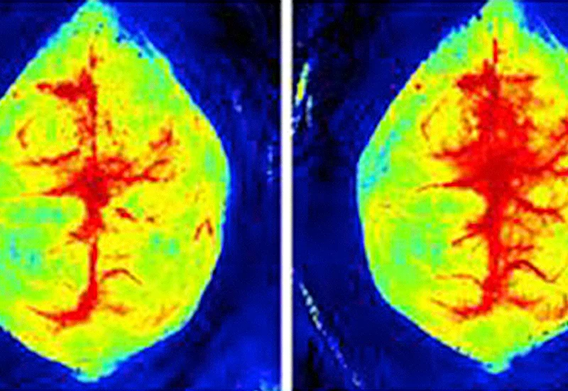 Middle cerebral artery occlusion (MCAO)