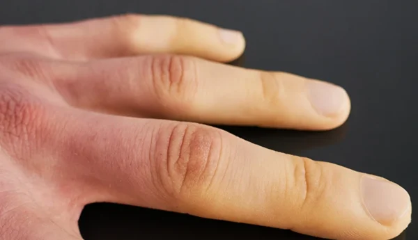 Raynaud’s Phenomenon