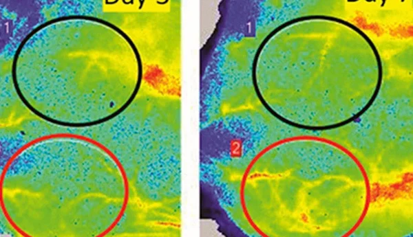 Neo­vascularization and angiogenesis