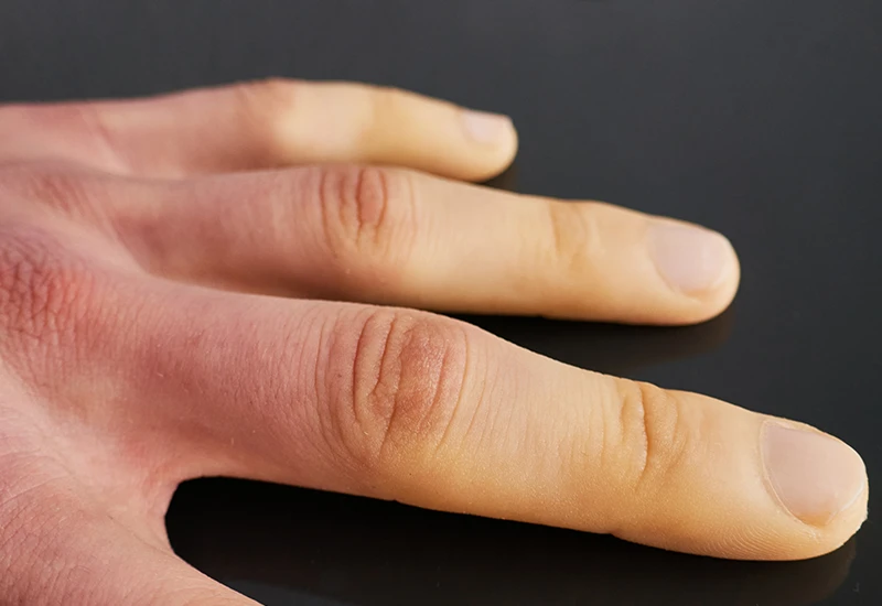 Raynaud’s Phenomenon